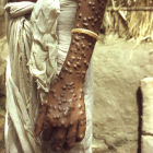 Boy with skin rash caused by smallpox, Bangladesh
